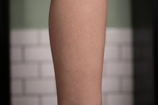 The same arm with ink almost entirely cleared after a full PicoWay course