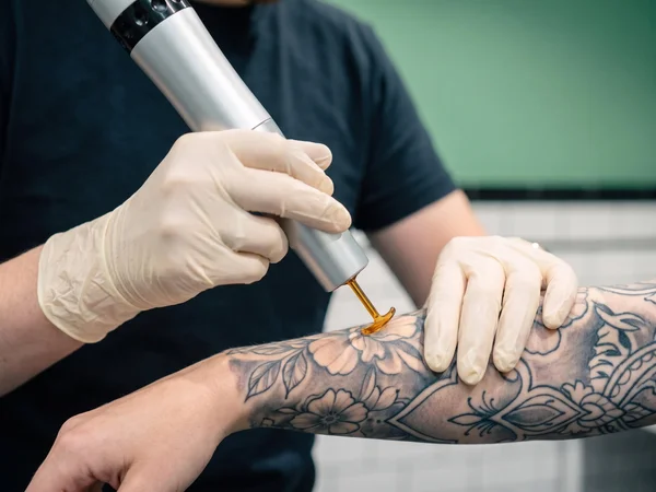 PicoWay handpiece treating a full black sleeve tattoo on a forearm